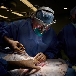 US man recovering after ‘breakthrough’ pig-heart transplant