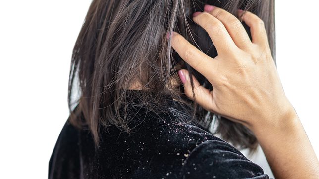 Are you suffering from severe itch and dandruff? It could be a case of ‘DERMdruff’