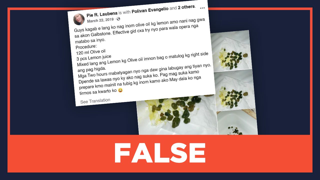 FALSE: Drinking lemon juice and olive oil will help you pass gallstones
