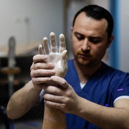 Bionic limbs lift Gaza amputees’ self-esteem
