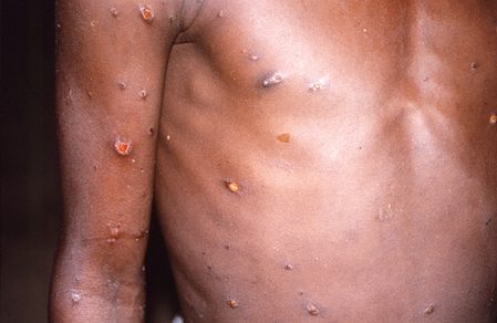 EXPLAINER: Why monkeypox cases are spreading in Europe, US