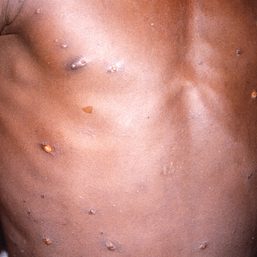 Philippines ‘intensifying’ border screening amid monkeypox threat