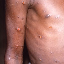 Massachusetts identifies first 2022 US case of monkeypox infection