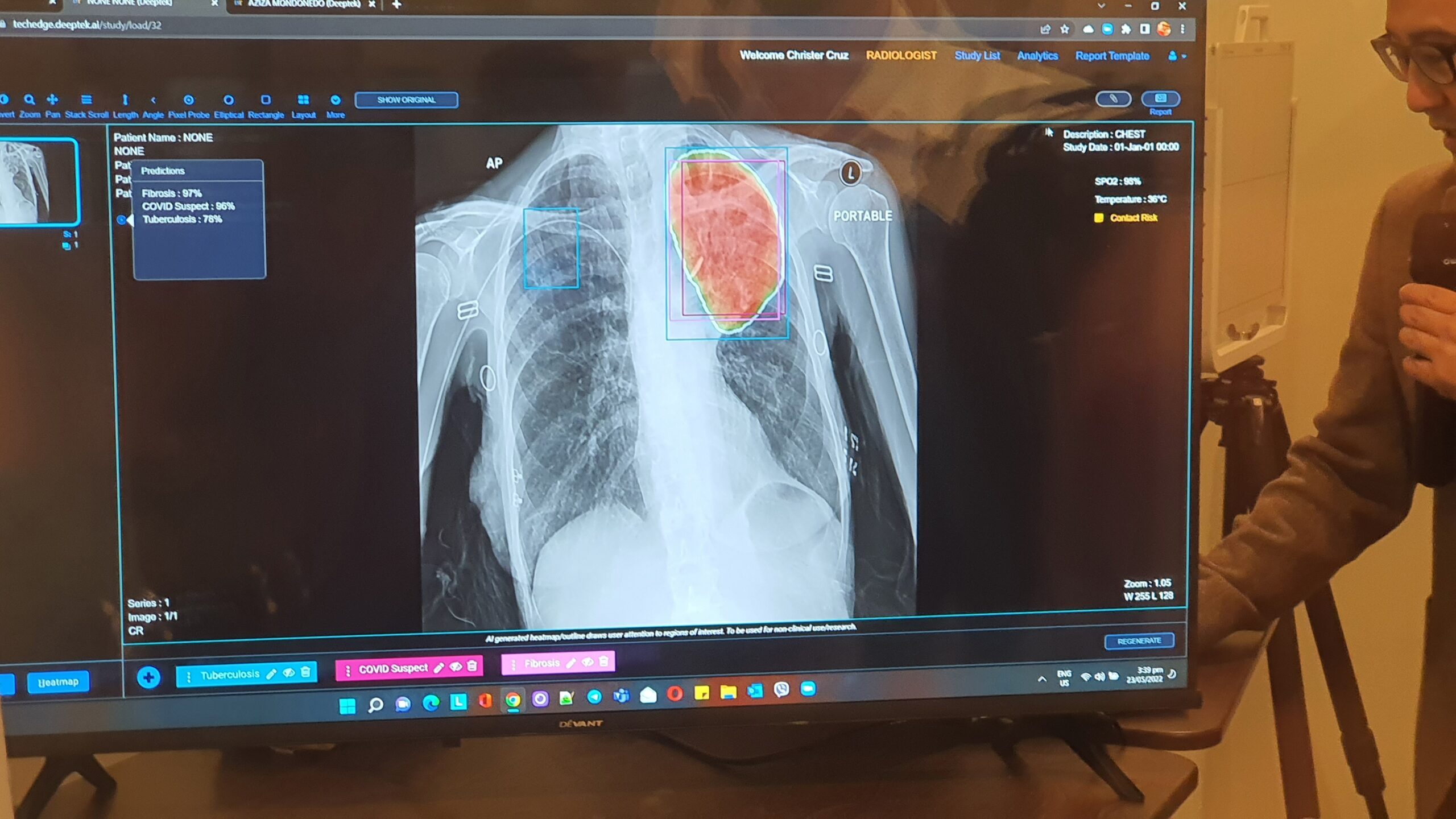 Maxicare, startup Advanced Abilities launch AI-powered x-ray platform