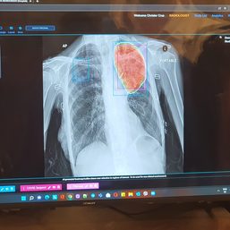 Maxicare, startup Advanced Abilities launch AI-powered x-ray platform