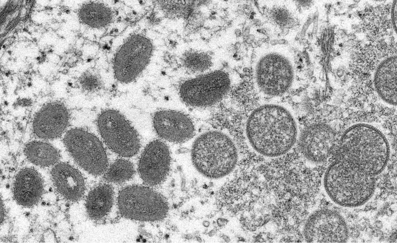Germany detects 1st case of monkeypox