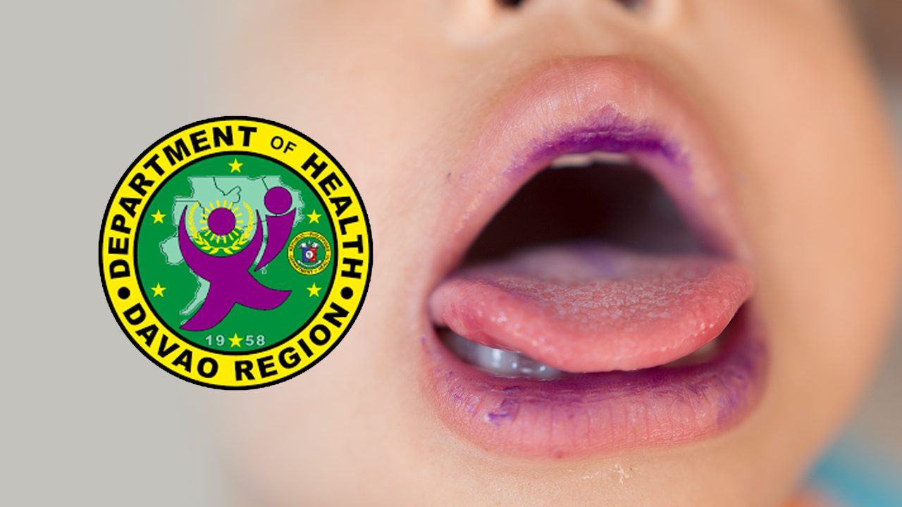 Hand, Foot, and Mouth Disease cases up in Davao