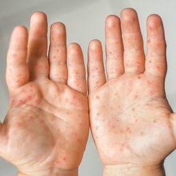 Borongan City, Eastern Samar declares hand, foot, and mouth disease outbreak