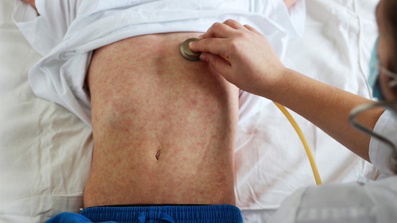 Zamboanga Peninsula most at risk as measles cases surge