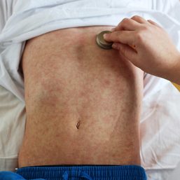BARMM health ministry declares measles outbreak across region