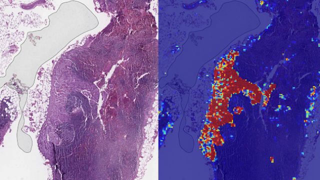 AI achieves 99% accuracy in finding metastatic breast cancer – Google