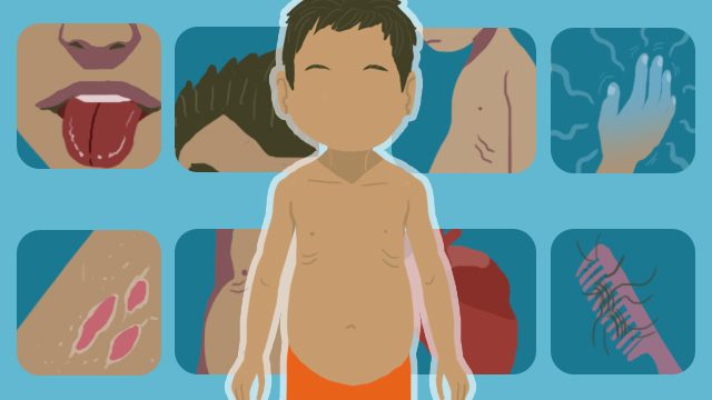 INFOGRAPHIC: How malnutrition affects a child