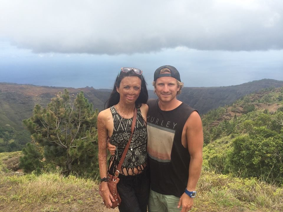 Atlet Australia Turia Pitt baru-baru ini umumkan pertunangannya dengan pacarnya, meski ia alami luka bakar di 65% bagian tubuhnya. Foto dari Facebook 