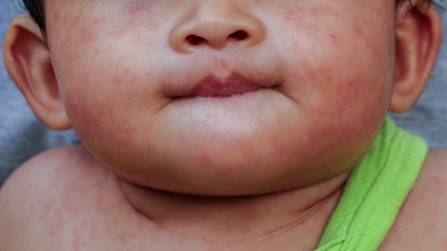 Davao Region reports 4 deaths in measles outbreak