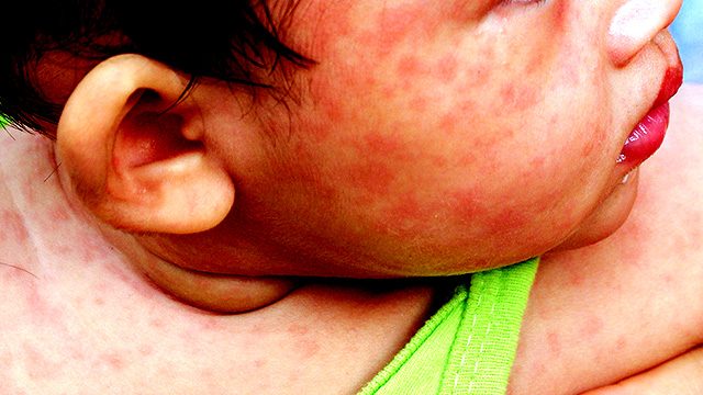 WHO warns of ‘backsliding’ in measles fight as cases soar worldwide
