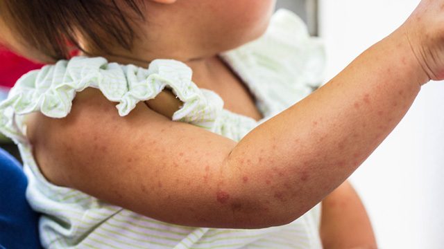 After Dengvaxia scare, measles cases soar to 598