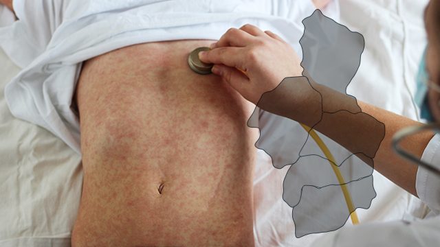DOH records 508% increase in measles cases in Cordillera