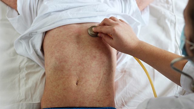 Dozens quarantined in California after measles exposure