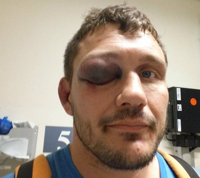 Matt Mitrione suffers gruesome eye injury at UFC Boston
