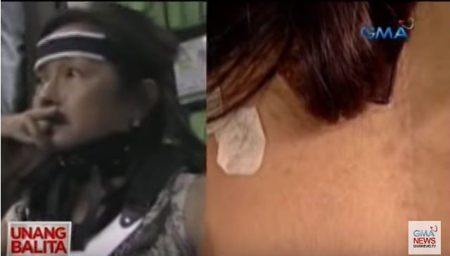 SCARS. A close-up of Speaker Gloria Macapagal Arroyo's back scars. Screenshot from GMA News' YouTube account 