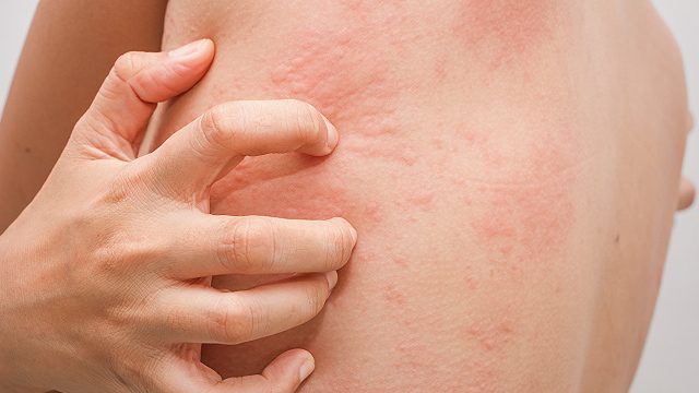 FAST FACTS: What is Chronic Spontaneous Urticaria?