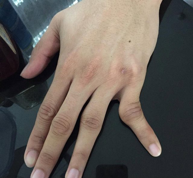 A photo posted to Marvin Espiritu's Instagram account shows the injury to Aguilar's finger 