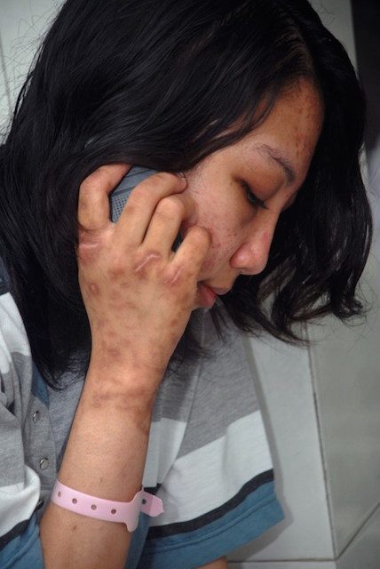Erwiana holds a mobile phone with her scarred hand before leaving the hospital in Sragen on February 5, 2014, almost a month after she first arrived. Photo by Anwar Mustafa/AFP 