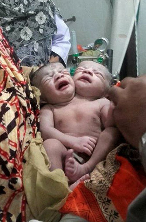 Bayi berkepala dua lahir di Bangladesh, ayah khawatir tak mampu rawat