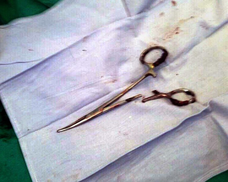 Scissors pulled from Vietnam man’s stomach 18 years after surgery