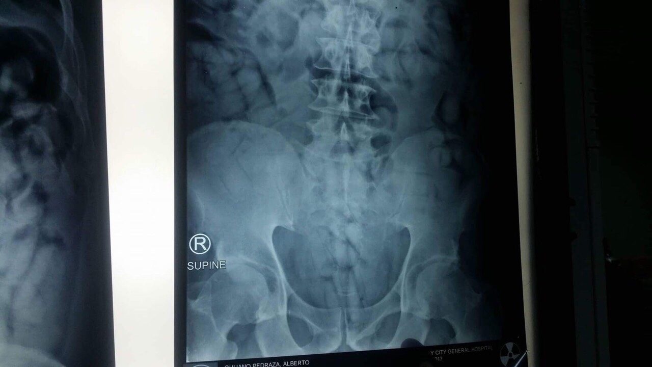 X-RAY. Authorities subject the suspect to an X-ray which confirms the presence of drug pellets in his gut. Photo from PDEA 