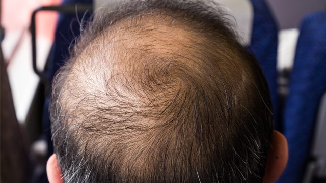 To baldly grow: Japan scientists regrow hair at record rate