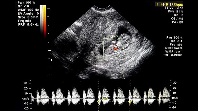 Louisiana lawmakers pass fetal heartbeat abortion ban