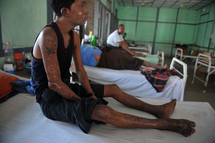 Leprosy: Myanmar struggles with ancient scourge