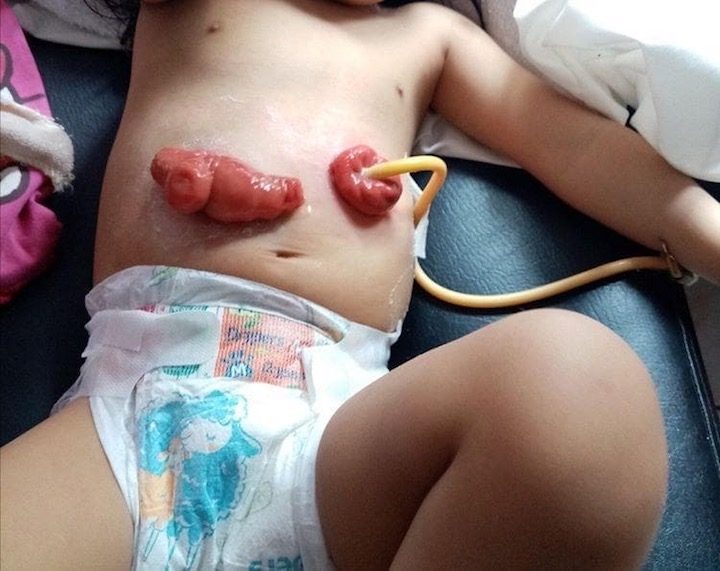 SPECIAL CONDITION. Joanna's son Kyle is fed through a tube that pumps food into his stomach. Photo from Cayabyab 