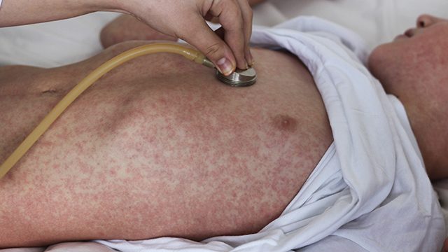 Measles death toll in Samoa rises to 15 – UNICEF