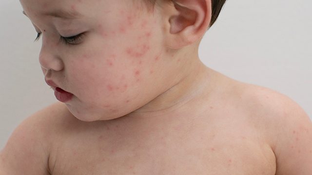 Measles cases rise 30% worldwide – WHO