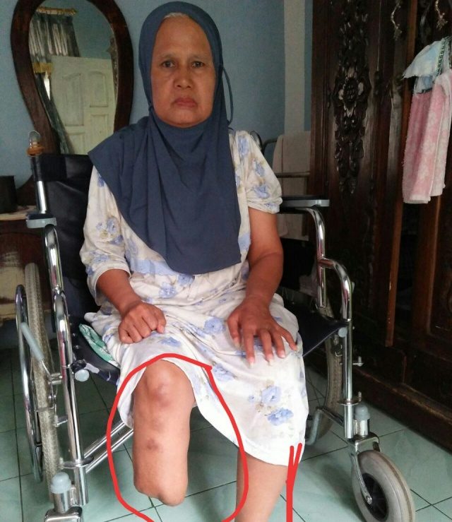 DIAMPUTASI. Zulfitri Zaini, warga Solok, Sumatera Barat terpaksa harus kehilangan kaki kanannya usai menjadi korban jatuhnya crane di komplek Masjidil Haram, Arab Saudi pada tahun 2015 lalu. Foto oleh LBH Padang  