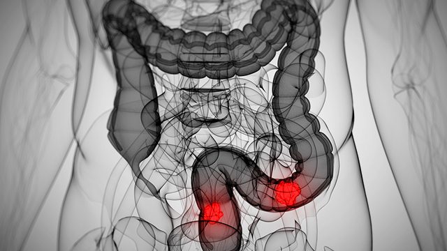 Colon cancer could surge among young – study
