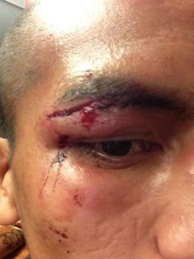 Milan Melindo shows off the cut he sustained on his right eye during his fight with Javier Mendoza. Photo from Melindo's Facebook 