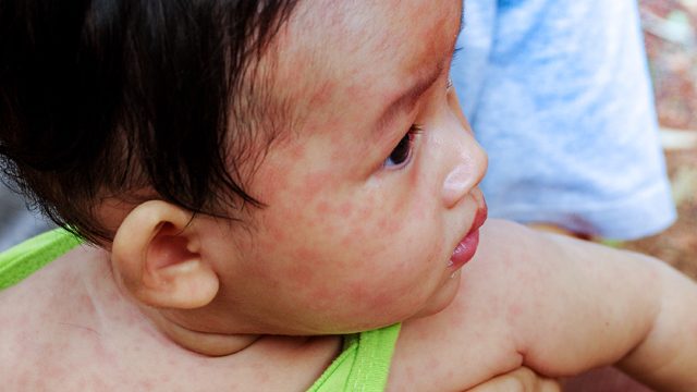 DOH declares measles outbreak in Taguig barangay