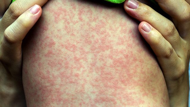 DOH monitoring suspected measles outbreak in Sarangani town