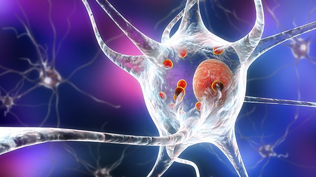 Japan team transplants stem cells into brain to treat Parkinson’s