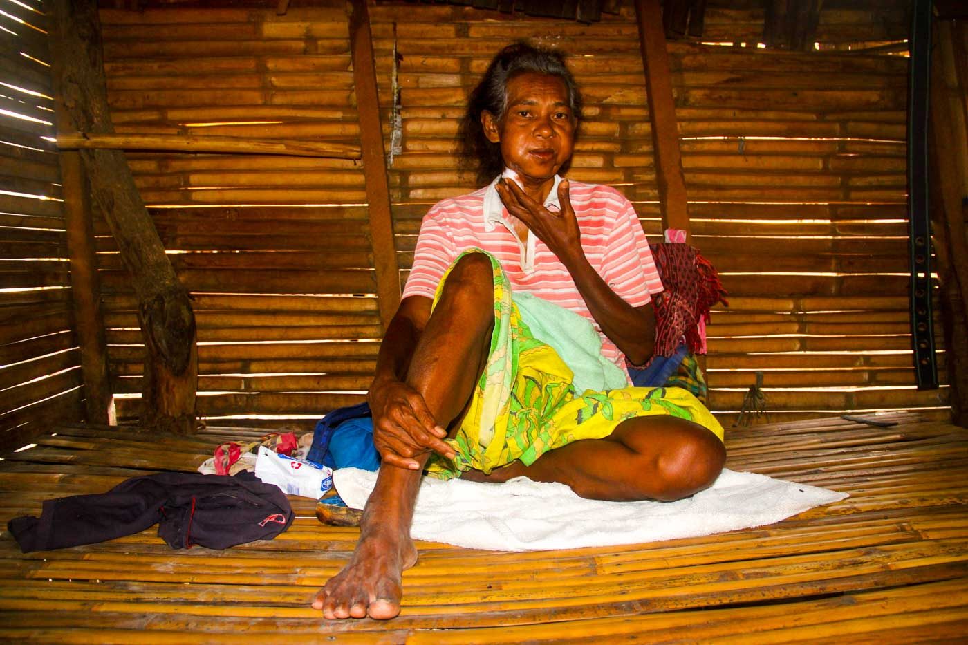 DOCUMENTED CASE. Claudia Vargas, 58, is one of 4 members of the Agta-tabangon tribe known to be suffering from mouth cancer. Photo by Rhaydz B. Barcia/Rappler  