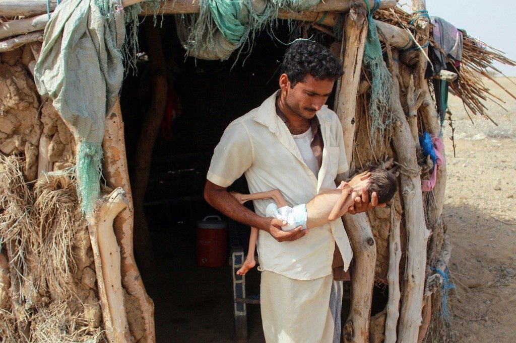 MALNUTRITION. The father of a 5-year-old girl suffering from acute malnutrition and weighing 3 kilograms holds her at the entrance of their impoverished house in Yemen's northern Hajjah province on June 23, 2020. Photo by Essa Ahmed/AFP 